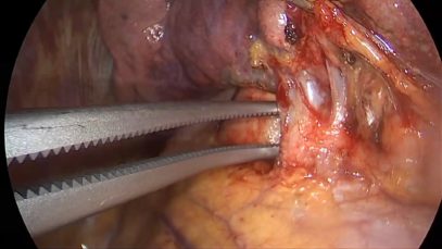 Vats left upper lobectomy