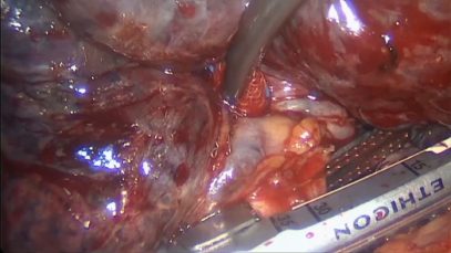 Vats right upper lobectomy