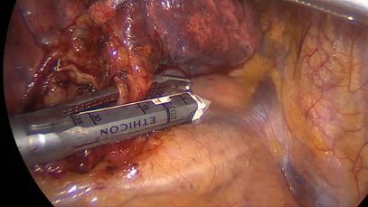 Vats right upper lobectomy.