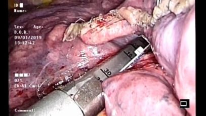 Middle lobectomy. M. Nosotti, L. Rosso, D.Tosi, A. Palleschi, I. Righi, P. Mendogni